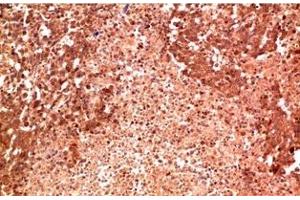 Immunohistochemistry of paraffin-embedded Human lung carcinoma tissue using P38 Monoclonal Antibody at dilution of 1:200. (MAPK14 Antikörper)