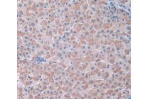 IHC-P analysis of Human Liver Cancer Tissue, with DAB staining. (CDK2 Antikörper  (AA 94-198))