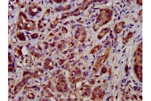 IHC image of ABIN7149946 diluted at 1:500 and staining in paraffin-embedded human pancreatic cancer performed on a Leica BondTM system. (TFB1M Antikörper  (AA 59-194))