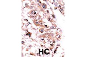 Formalin-fixed and paraffin-embedded human hepatocellular carcinoma tissue reacted with PPP3CC polyclonal antibody  , which was peroxidase-conjugated to the secondary antibody, followed by AEC staining. (PPP3CC Antikörper  (C-Term))