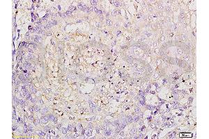 Formalin-fixed and paraffin embedded human esophageal carcinoma labeled with Anti-ROCK1 Polyclonal Antibody, Unconjugated (ABIN738636) at 1:200 followed by conjugation to the secondary antibody and DAB staining. (ROCK1 Antikörper  (AA 1001-1200))