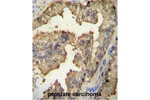 PRMT4 Antibody (Center) immunohistochemistry analysis in formalin fixed and paraffin embedded human prostate carcinoma followed by peroxidase conjugation of the secondary antibody and DAB staining. (CARM1 Antikörper  (Middle Region))