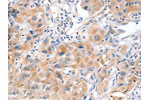 The image on the left is immunohistochemistry of paraffin-embedded Human lung cancer tissue using ABIN7128172(ACOX2 Antibody) at dilution 1/20, on the right is treated with fusion protein. (Acox2 Antikörper)