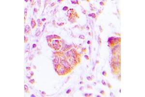 Immunohistochemical analysis of MOV10L1 staining in human lung cancer formalin fixed paraffin embedded tissue section. (MOV10L1 Antikörper  (Center))