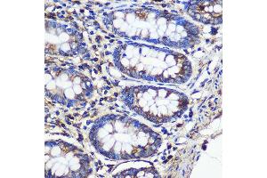 Immunohistochemistry of paraffin-embedded Human colon using SND1 Rabbit pAb (ABIN6129741, ABIN6148197, ABIN6148199 and ABIN6221577) at dilution of 1:100 (40x lens). (SND1 Antikörper  (AA 26-285))