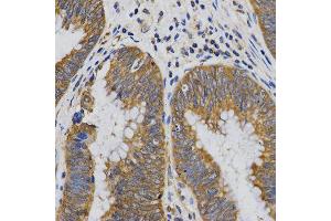 Immunohistochemistry of paraffin-embedded human rectal cancer tissue using PIBF1 antibody at dilution of 1:200 (x400 lens). (PIBF1 Antikörper)