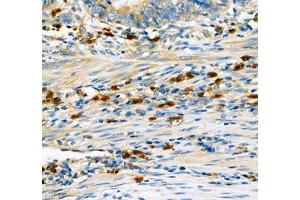 Immunohistochemistry of paraffin embedded human gastric cancer using CD307 (ABIN7073931) at dilution of 1:600 (300x lens)
