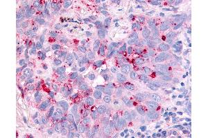 Anti-CDC7 antibody IHC of human Lung, Non-Small Cell Carcinoma. (CDC7 Antikörper  (Kinase Domain))
