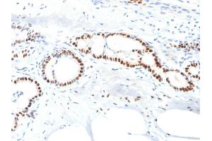 Formalin-fixed, paraffin-embedded human Breast Carcinoma stained with Estrogen Receptor alpha Mouse Monoclonal Antibody (ESR1/1904). (Estrogen Receptor alpha Antikörper)