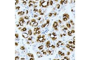 Immunohistochemical analysis of BPGM staining in human gastric cancer formalin fixed paraffin embedded tissue section. (BPGM Antikörper)