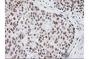 Immunohistochemical staining of paraffin-embedded Adenocarcinoma of Human breast tissue using anti-MGLL mouse monoclonal antibody.
