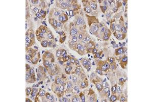 Immunohistochemistry of paraffin-embedded human liver cancer using UGT1A9 antibody. (UGT1A9 Antikörper)