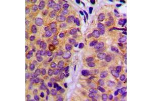 Immunohistochemical analysis of PLC gamma 2 (pY753) staining in human breast cancer formalin fixed paraffin embedded tissue section.