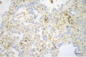 Immunohistochemistry was performed on paraffin-embedded human lung adenocarcinoma using beta actin antibody (ABIN7797467), 1:200). (Rekombinanter beta Actin Antikörper)