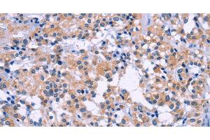 Immunohistochemistry of paraffin-embedded Human thyroid cancer tissue using DUSP22 Polyclonal Antibody at dilution 1:60 (DUSP22 Antikörper)