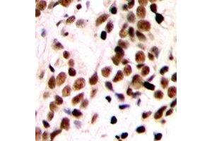 Immunohistochemical analysis of GTF2IRD1 staining in human breast cancer formalin fixed paraffin embedded tissue section. (GTF2IRD1 Antikörper  (N-Term))