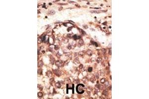 Formalin-fixed and paraffin-embedded human cancer tissue reacted with the primary antibody, which was peroxidase-conjugated to the secondary antibody, followed by AEC staining. (MMP8 Antikörper  (AA 286-315))