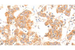 Immunohistochemistry of paraffin-embedded Human breast cancer using PRDX2 Polyclonal Antibody at dilution of 1:80 (Peroxiredoxin 2 Antikörper)