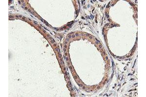 Immunohistochemical staining of paraffin-embedded Human breast tissue using anti-ILVBL mouse monoclonal antibody. (ILVBL Antikörper)