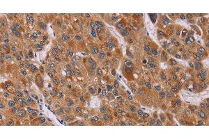 Immunohistochemistry of paraffin-embedded Human liver cancer tissue using CALCA Polyclonal Antibody at dilution 1:40 (CGRP Antikörper)