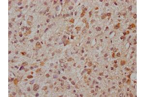 IHC image of ABIN7166521 diluted at 1:300 and staining in paraffin-embedded human glioma cancer performed on a Leica BondTM system. (PCDHa8 Antikörper  (AA 719-922))