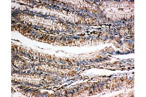 Anti-Gelsolin antibody, IHC(P) IHC(P): Human Intestinal Cancer Tissue (Gelsolin Antikörper  (C-Term))