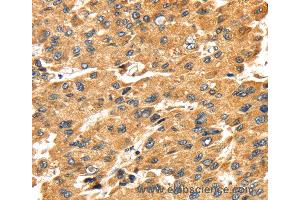 Immunohistochemistry of Human breast cancer using SH3KBP1 Polyclonal Antibody at dilution of 1:45