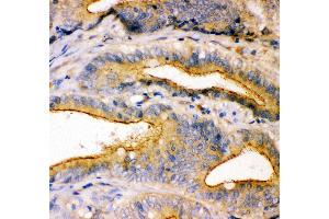 Anti- TJP1 antibody, IHC(P) IHC(P): Human Intestinal Cancer Tissue (TJP1 Antikörper  (AA 1178-1527))