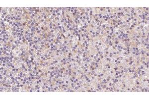 ABIN6273082 at 1/100 staining Human lymph cancer tissue by IHC-P. (Tropomodulin 4 Antikörper  (Internal Region))