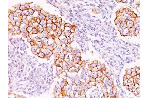 Formalin-fixed, paraffin-embedded human Breast Carcinoma stained with Phosphotyrosine Mouse Monoclonal Antibody (PY20). (Phosphotyrosine Antikörper)