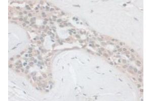 IHC-P analysis of Human Breast Cancer Tissue, with DAB staining. (PCSK1 Antikörper  (AA 500-738))