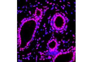 Immunofluorescence of paraffin embedded human breast cancer using smad62024 (ABIN7075629) at dilution of 1:1000 (400x lens)