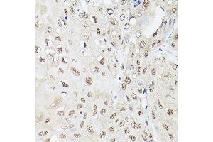 Immunohistochemistry of paraffin-embedded human esophageal cancer using UBQLN2 Rabbit pAb (ABIN6127815, ABIN6149859, ABIN6149860 and ABIN6225041) at dilution of 1:250 (40x lens). (Ubiquilin 2 Antikörper  (AA 1-150))