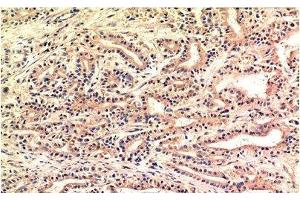 Immunohistochemistry of paraffin-embedded Human stomach carcinoma tissue using CHOP Monoclonal Antibody at dilution of 1:200. (DDIT3 Antikörper)