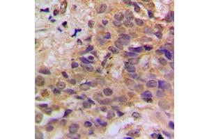 Immunohistochemical analysis of p53 (pS37) staining in human breast cancer formalin fixed paraffin embedded tissue section. (p53 Antikörper  (N-Term, pSer37))