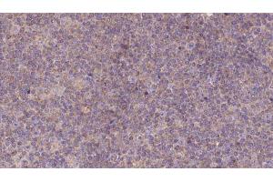 ABIN6273139 at 1/100 staining Human lymph cancer tissue by IHC-P.