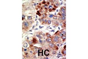 Formalin-fixed and paraffin-embedded human hepatocellular carcinoma tissue reacted with AR polyclonal antibody , which was peroxidase-conjugated to the secondary antibody, followed by DAB staining.