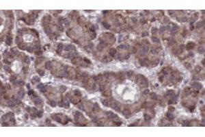 ABIN6273923 at 1/100 staining Human liver cancer tissue by IHC-P. (CCKBR Antikörper  (N-Term))