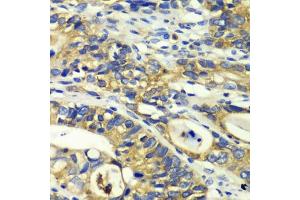 Immunohistochemistry of paraffin-embedded human colon carcinoma using RPH3A antibody (ABIN6128668, ABIN6147094, ABIN6147096 and ABIN6217639) at dilution of 1:100 (40x lens). (RPH3A Antikörper  (AA 1-280))