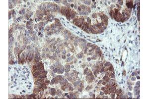 Immunohistochemical staining of paraffin-embedded Adenocarcinoma of Human ovary tissue using anti-TBCC mouse monoclonal antibody. (TBCC Antikörper)