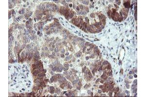 Immunohistochemical staining of paraffin-embedded Adenocarcinoma of Human ovary tissue using anti-TBCC mouse monoclonal antibody.
