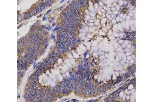 Immunohistochemistry of paraffin-embedded Human rectum cancer using EPHX2 Polyclonal Antibody at dilution of 1:200 (40x lens). (EPHX2 Antikörper)