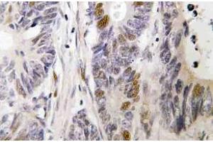 Immunohistochemistry (IHC) analyzes of c-Fos antibody in paraffin-embedded human colon carcinoma tissue. (c-FOS Antikörper)