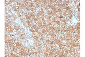 Formalin-fixed, paraffin-embedded human Prostate Carcinoma stained with CD63 Rabbit Recombinant Monoclonal Antibody (LAMP3/2990R). (Rekombinanter CD63 Antikörper)