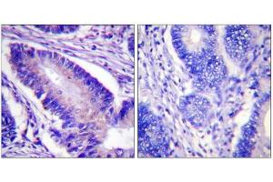 Immunohistochemistry analysis of paraffin-embedded human colon carcinoma tissue using eIF4B (Phospho-Ser422) antibody. (EIF4B Antikörper  (pSer422))