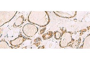 Immunohistochemistry of paraffin-embedded Human thyroid cancer tissue using ISOC2 Polyclonal Antibody at dilution of 1:95(x200)