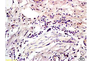 Formalin-fixed and paraffin embedded human colon carcinoma labeled with Anti-CD45RO Polyclonal Antibody, Unconjugated (ABIN733283) at 1:200 followed by conjugation to the secondary antibody and DAB staining (CD45RO Antikörper)
