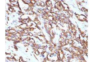Immunohistochemical staining (Formalin-fixed paraffin-embedded sections) of human angiosarcoma with VIM monoclonal antibody, clone VM1170 . (Vimentin Antikörper)