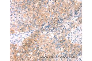 Immunohistochemistry of Human breast cancer using SNAP23 Polyclonal Antibody at dilution of 1:25 (SNAP23 Antikörper)