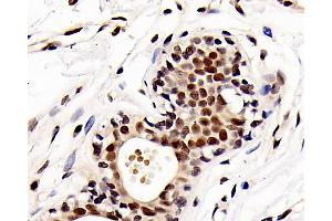 Immunohistochemistry analysis of paraffin-embedded human breast cancer using HDAC1 Polyclonal Antibody at dilution of 1:300. (HDAC1 Antikörper)